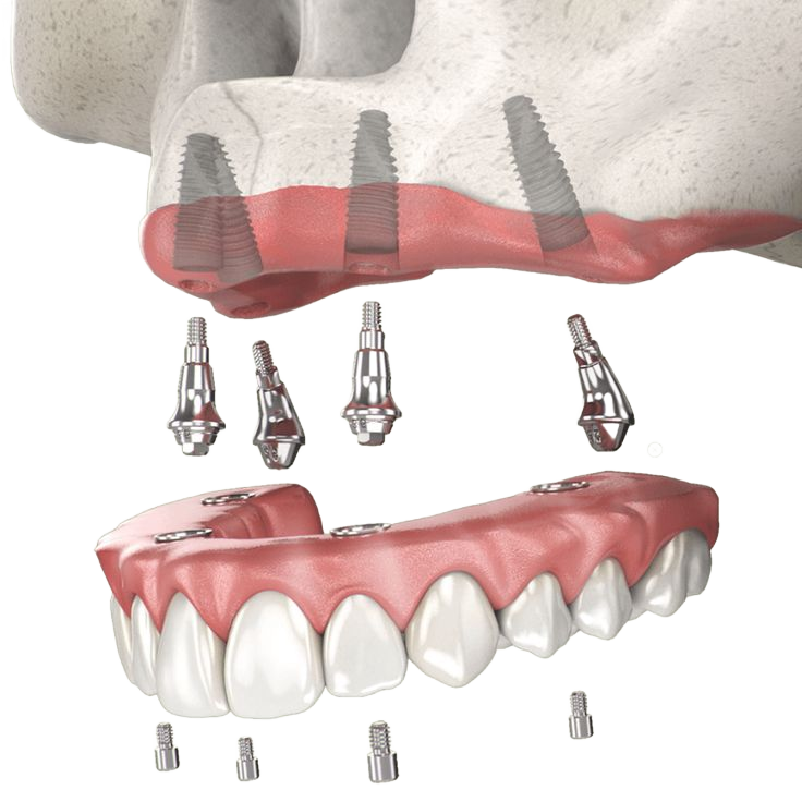 Dinți ficși pe implanturi