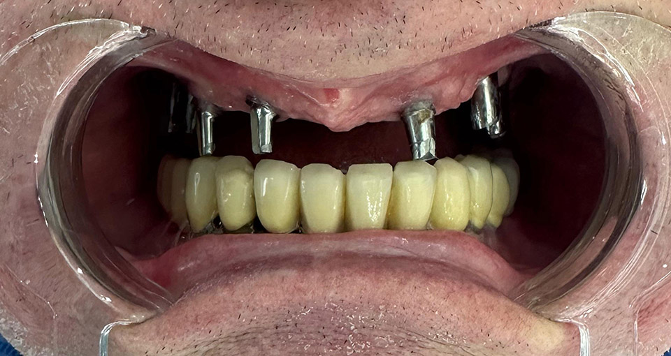 Pacientul după procedură