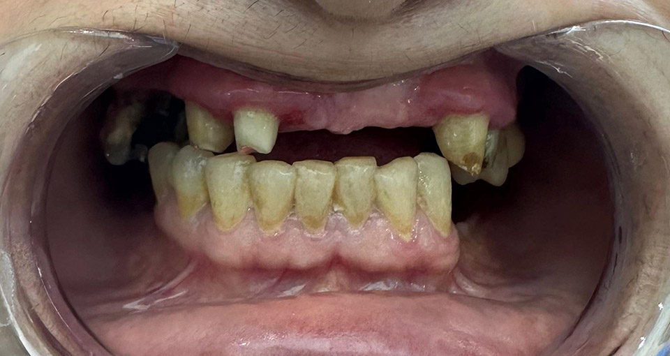 Pacientul după procedură