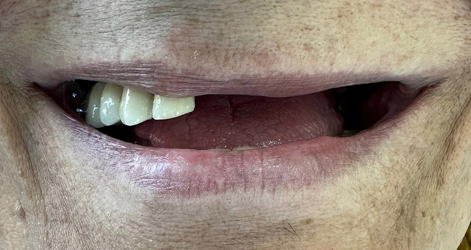 Pacientul după procedură