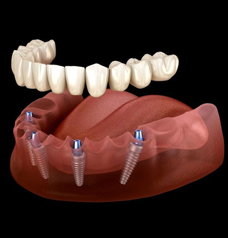 Model 3D Implant Dentar All-on-X